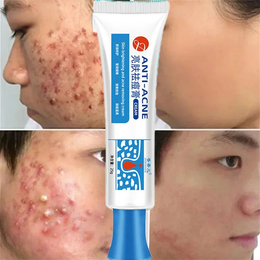 Salicylic Acid Acne Removal Cream Redness Pimple Spots Deep Cleaning