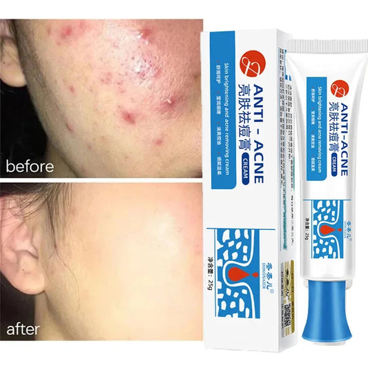 Salicylic Acid Acne Removal Cream Redness Pimple Spots Deep Cleaning